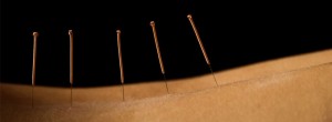 acupuncture